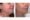 Exilis Ultra 360° Skin Rejuvenation